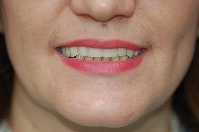 After Sparkle Dental treatment