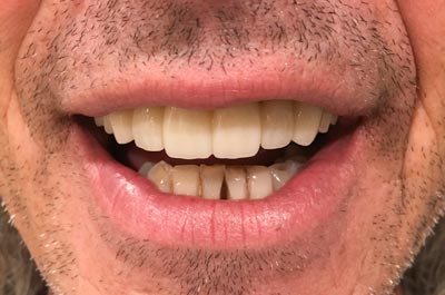 After Sparkle Dental treatment