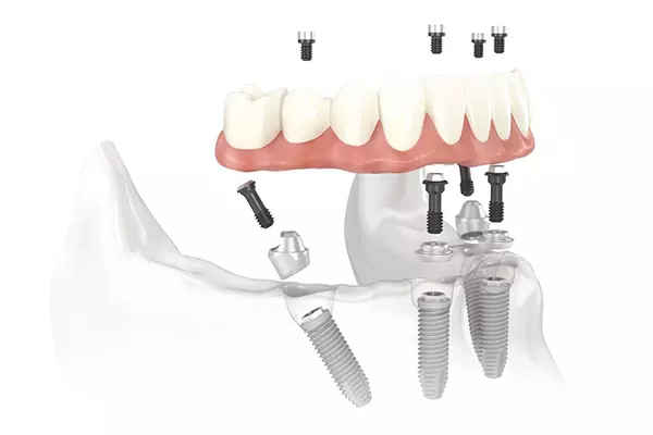 Diagram of All-on-4 Treatment Concept implant bridge placed in the jaw