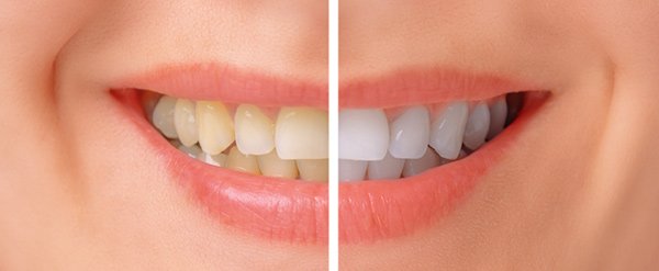 Yellow smile before and after teeth whitening